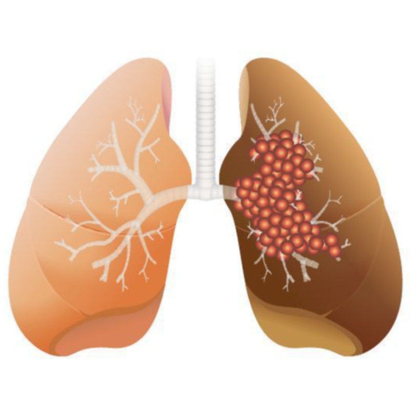 Η υψηλή δόση NMN αναστέλλει την ανάπτυξη του αδενοκαρκίνωμα των πνευμόνων